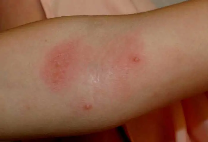 Natural Remedies For Deep Acne Scars Natural Remedies For Deep Acne Scars