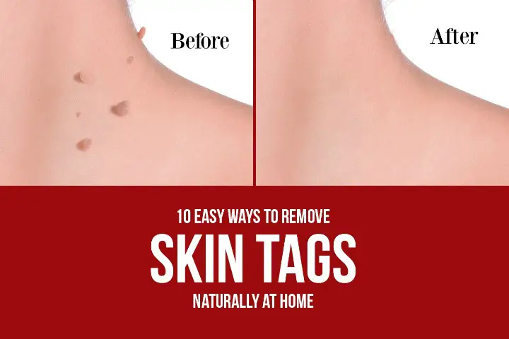 10 Easy Ways to Remove Skin Tags Naturally at Home