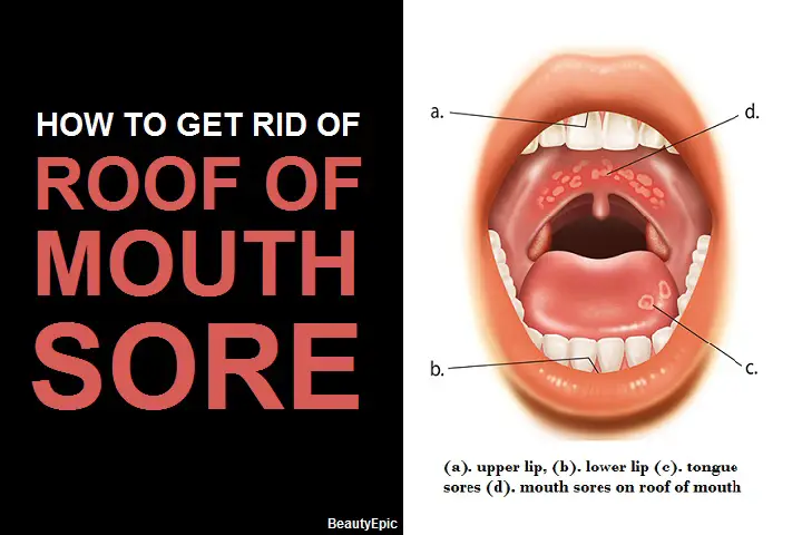 5 Simple Ways to Get Rid of Roof of Mouth Sore at Home