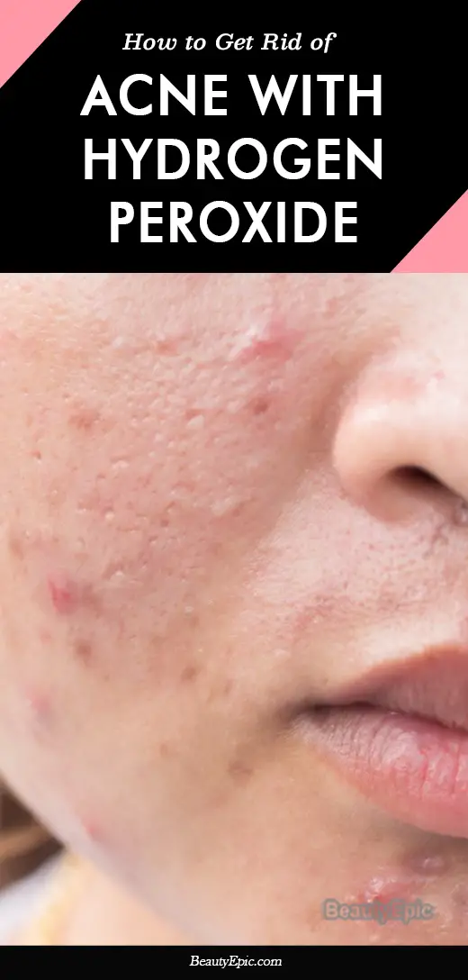 How to Use Hydrogen Peroxide for Acne?