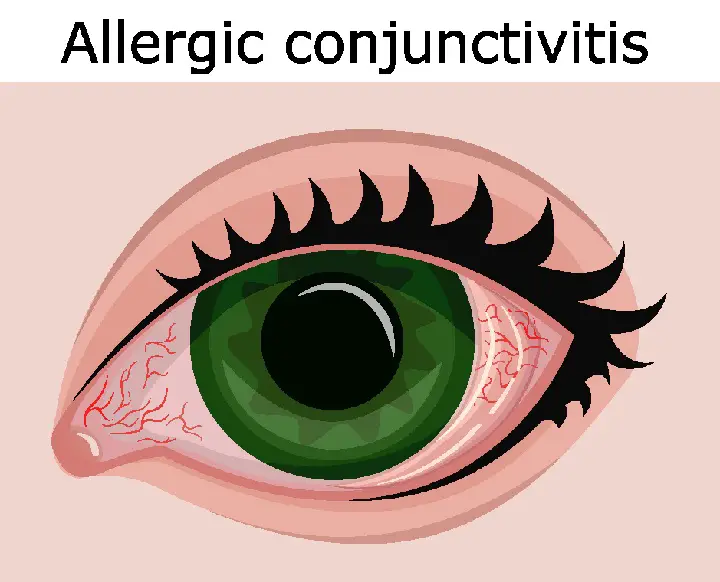 Allergic Conjunctivitis