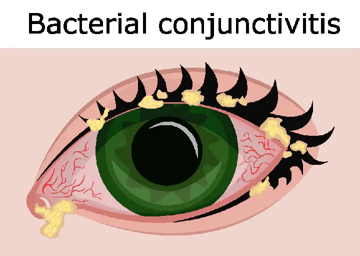 Bacterial Conjunctivitis