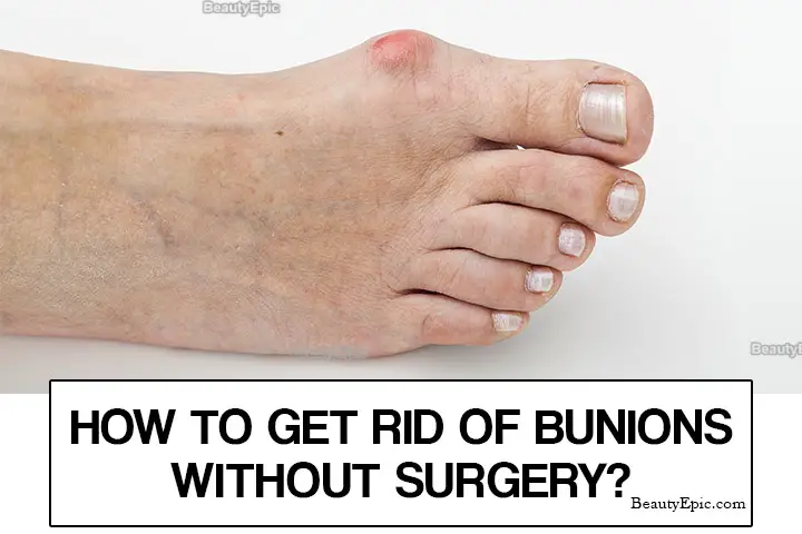 Rid of Bunions