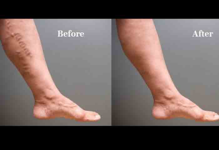 how to get rid of varicose veins naturally in 2 weeks