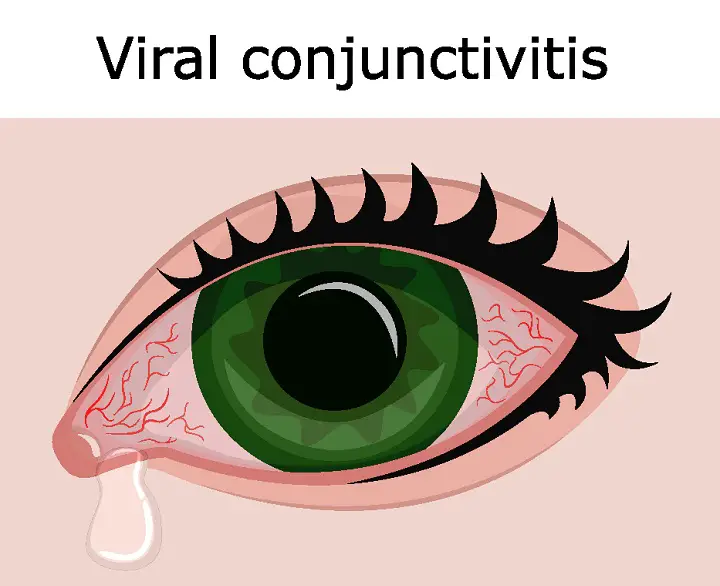 Viral Conjunctivitis
