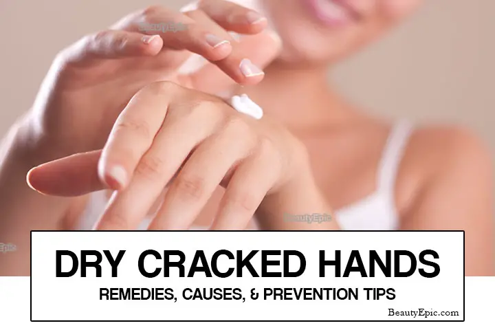 dry cracked hands