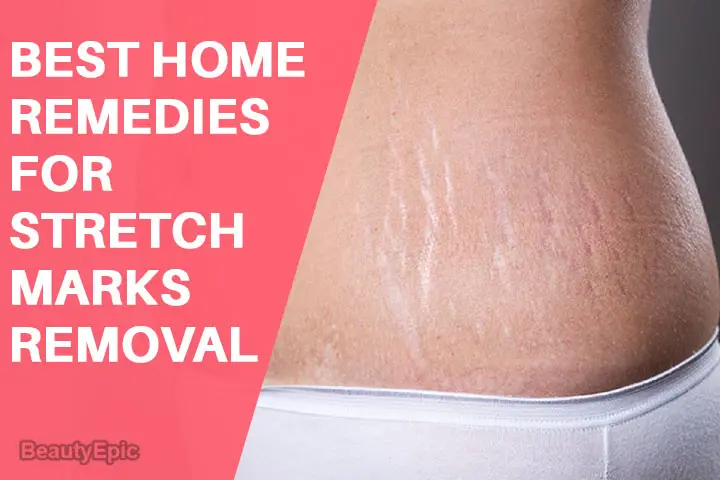 home remedies for stretch marks