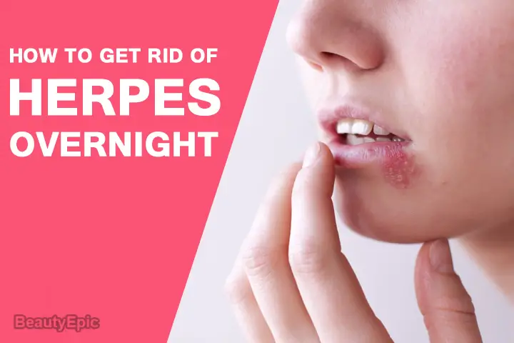 how to get rid of herpes overnight