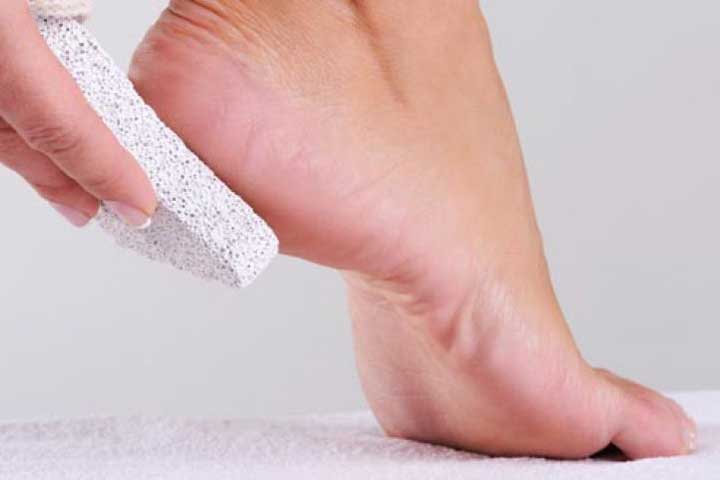 get rid of calluses