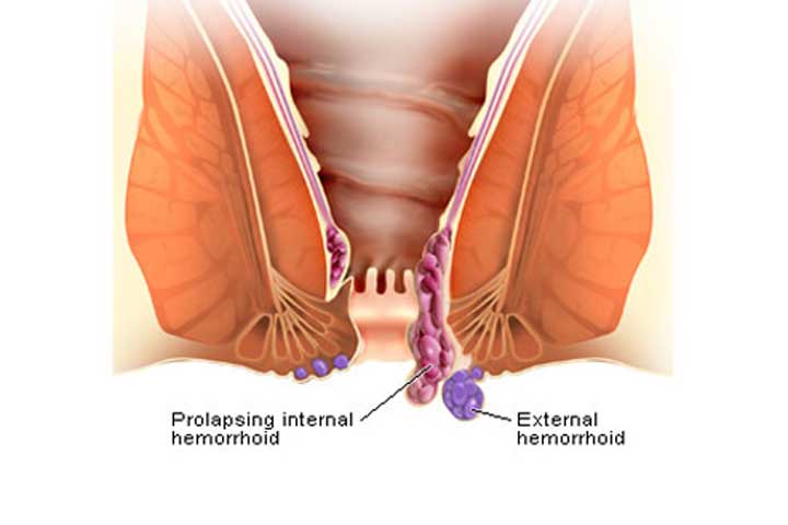 Hemorrhoids