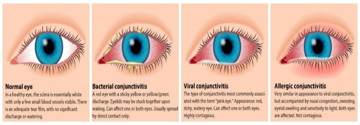 eye infection compressor