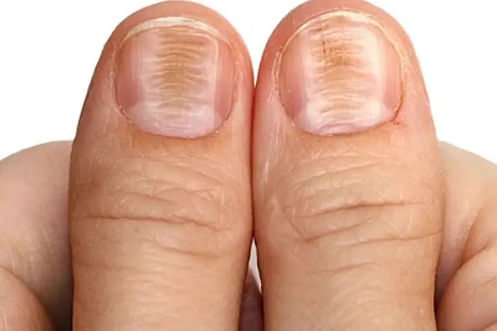 horizontal ridges on fingernails