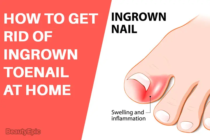 how to get rid of an ingrown toenail