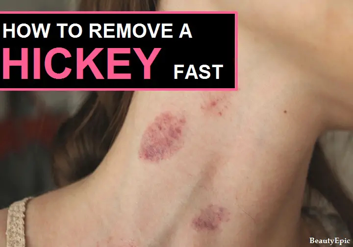 how to remove a hickey