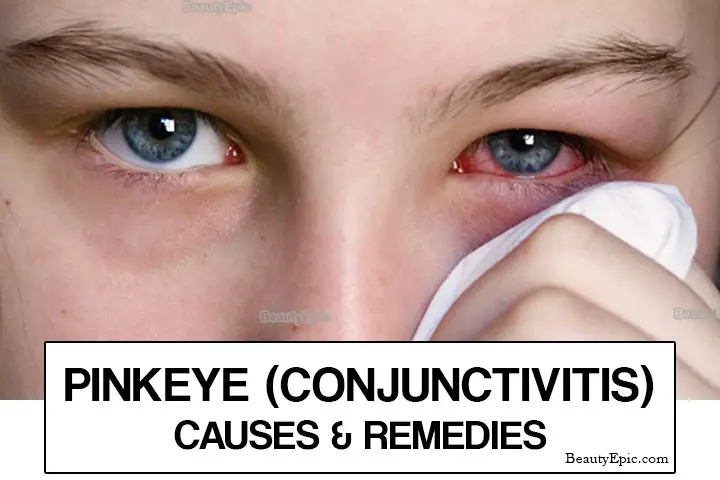 how to treat pink eye at home