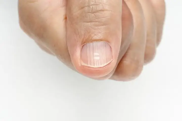 vertical ridges on fingernails