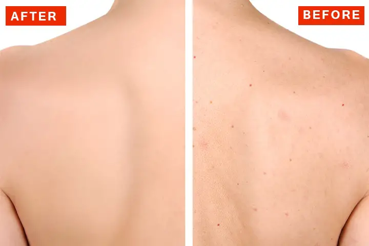 how to get rid of back acne