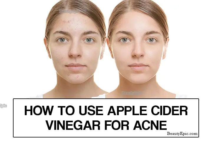 Apple Cider Vinegar for Acne