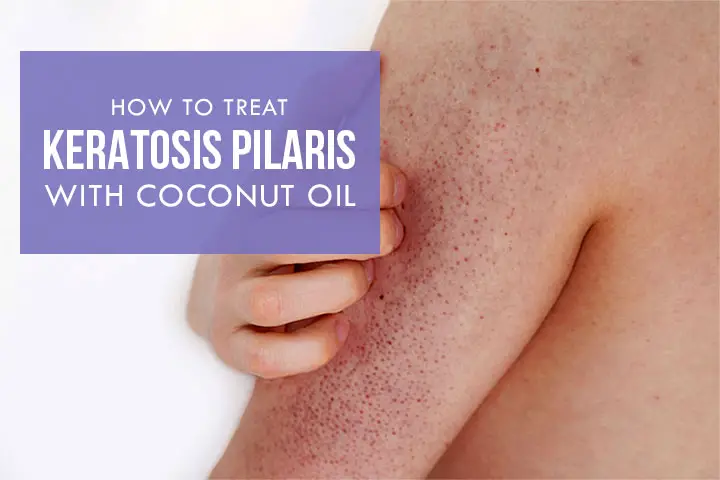 Coconut Oil for Keratosis Pilaris