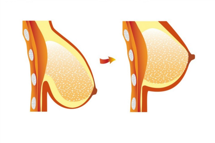 Home Remedies for Sagging Breast