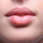 How To Remove Skin Tags With Tea Tree Oil?