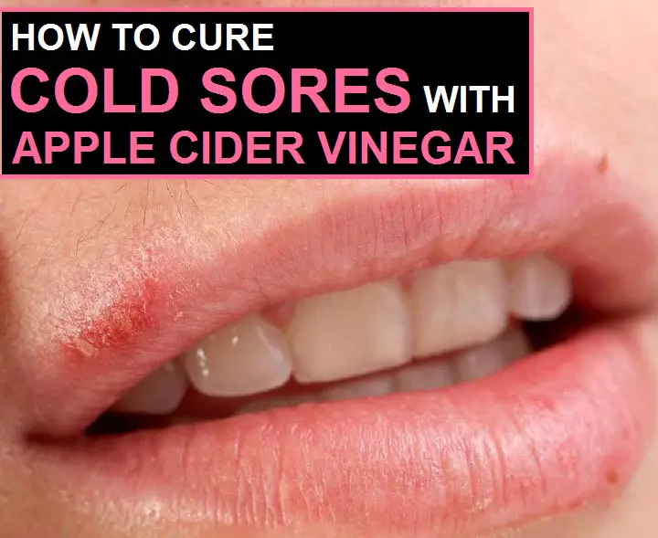 apple cider vinegar for cold sores