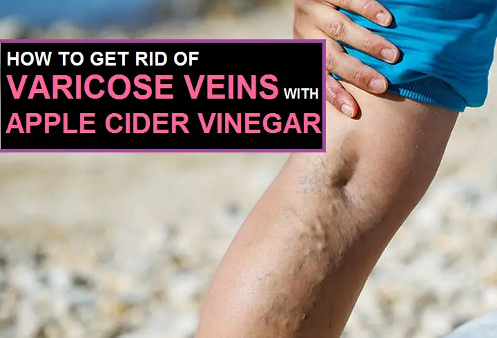 apple cider vinegar for varicose veins