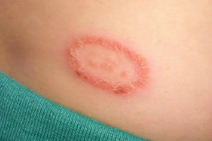 Apple Cider Vinegar for Ringworm