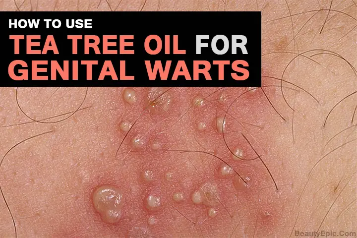 Effective To Use Tea Tree Oil For Genital Warts