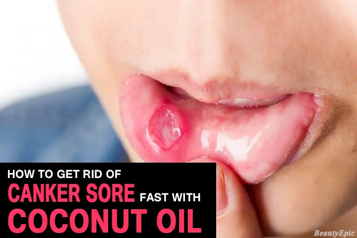 coconut oil for canker sores