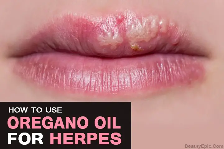 How to Use Oregano Oil for Herpes