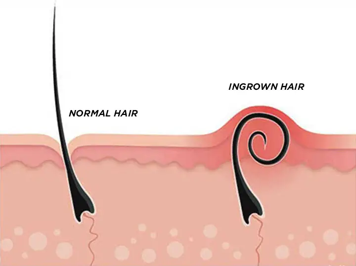 Tea Tree Oil For Ingrown Hair