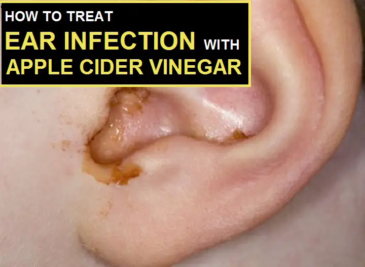 apple cider vinegar for ear infection