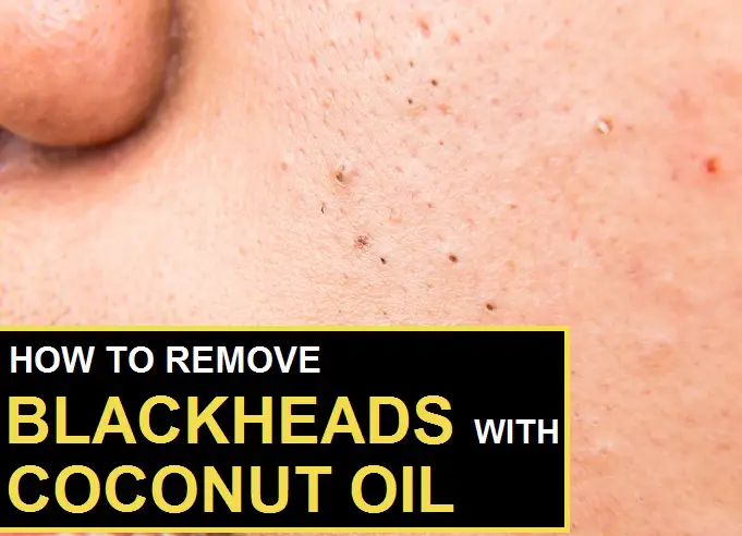 coconut oil for blackheads