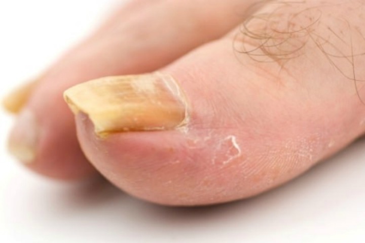 Apple Cider Vinegar For Toenail Fungus