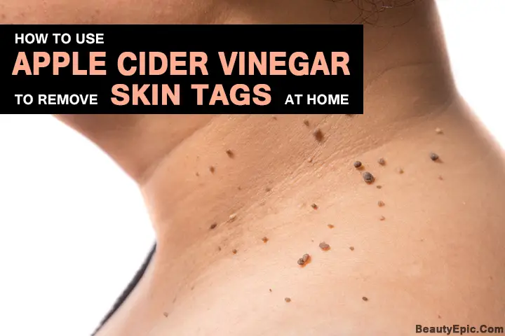 How Does Apple Cider Vinegar Remove Skin Tags?