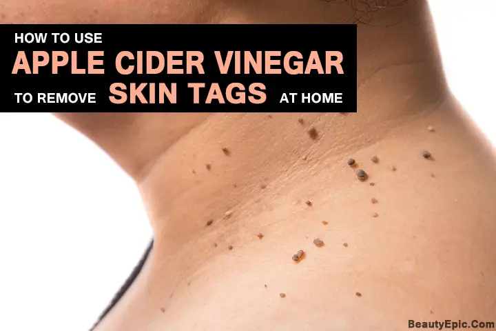 apple cider vinegar for skin tags