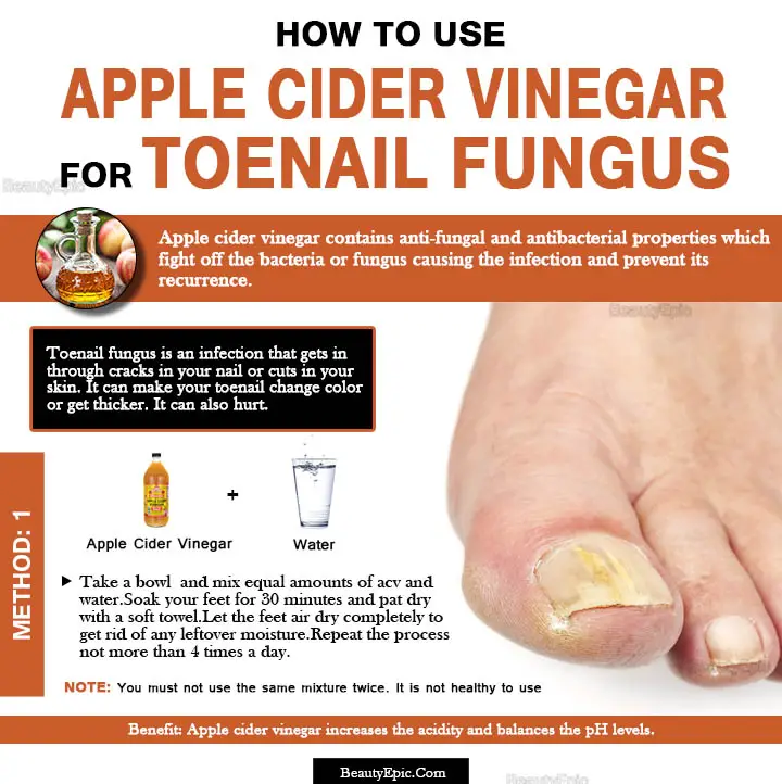 apple cider vinegar for toenail fungus