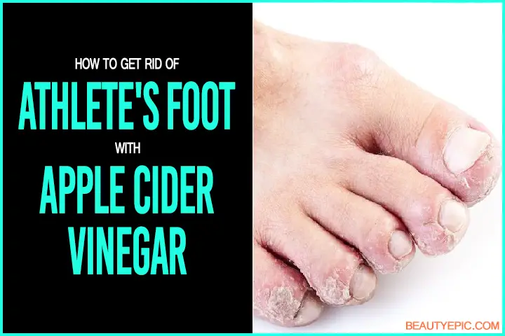 Apple Cider Vinegar for Athletes Foot