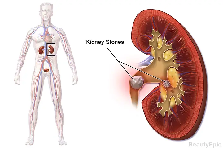 Apple Cider Vinegar for Kidney Stones