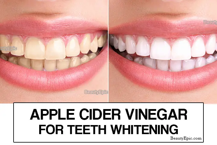 Apple Cider Vinegar for teeth whitening