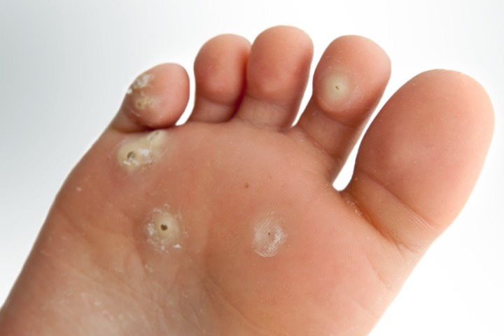 apple cider vinegar foot soak for callus