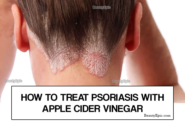 apple cider vinegar for psoriasis treatment