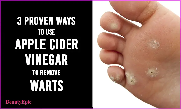 apple cider vinegar for warts