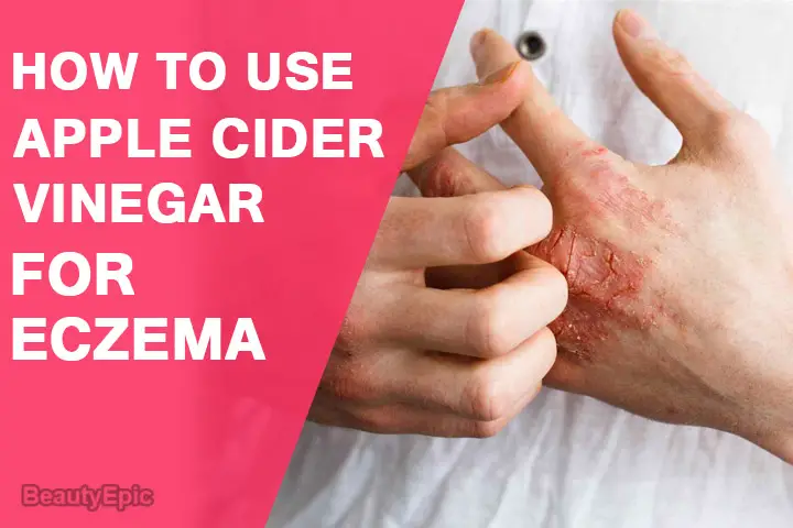 apple cider vinegar for eczema