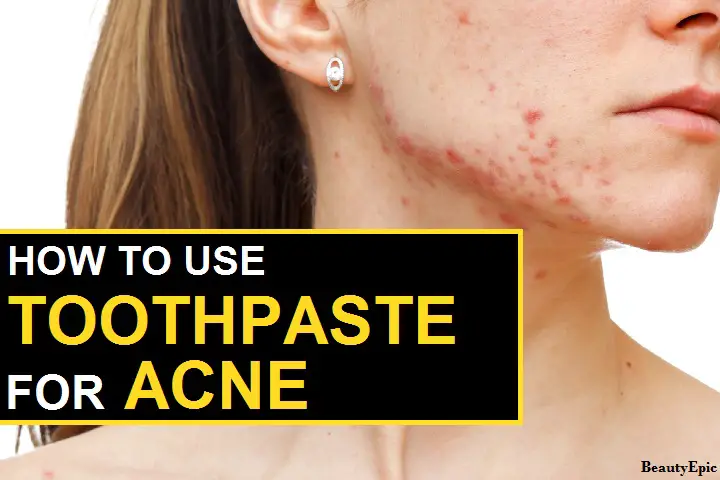 toothpaste for acne