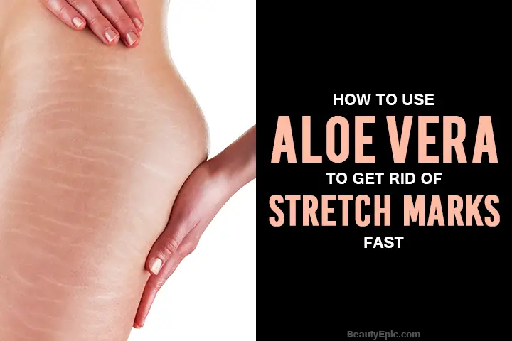 aloe vera for stretch marks