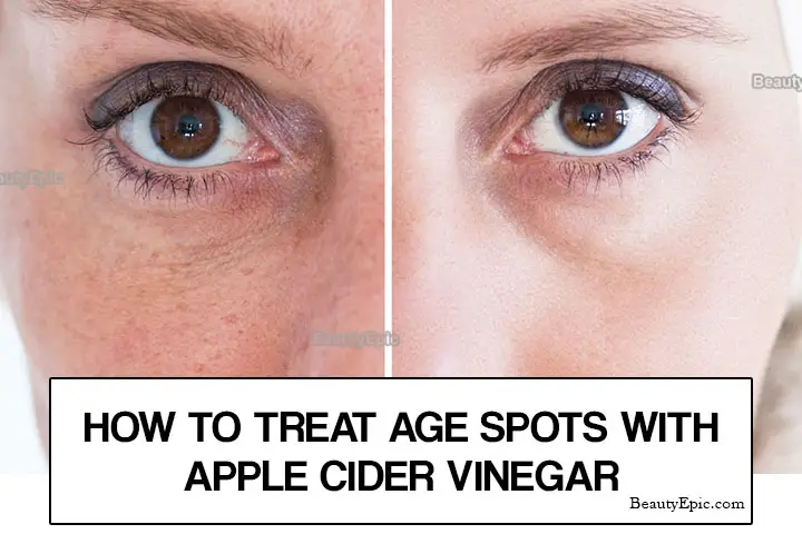 apple cider vinegar for age spots