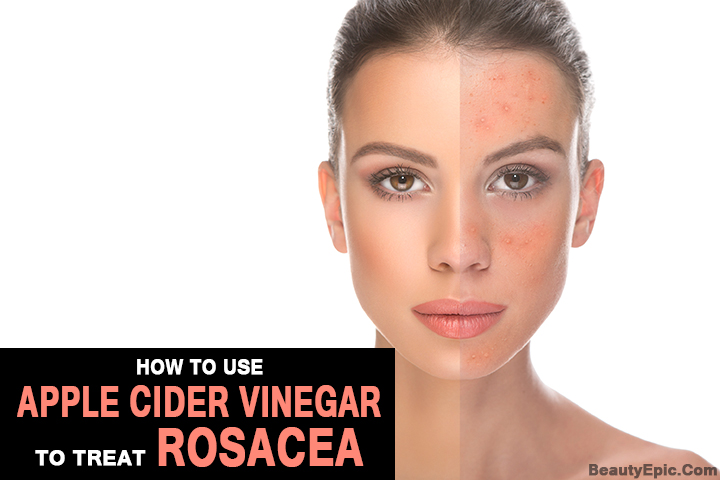 apple cider vinegar for rosacea