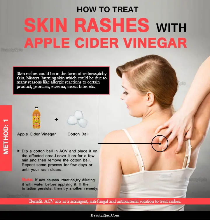 apple cider vinegar for skin rash